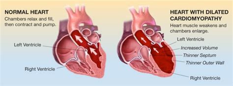 how long can you live with dilated cardiomyopathy.